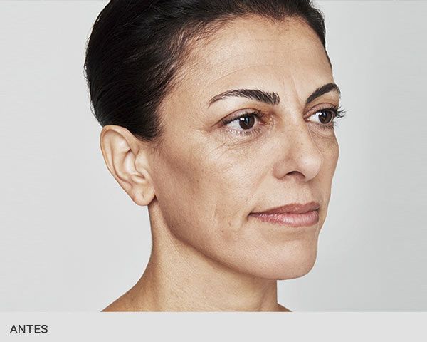 eliminar arrugas con laser antes