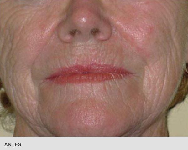 laser para arrugas antes