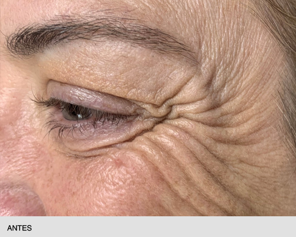 Neuromoduladores para ojos antes
