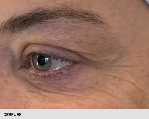 Neuromoduladores para ojos después