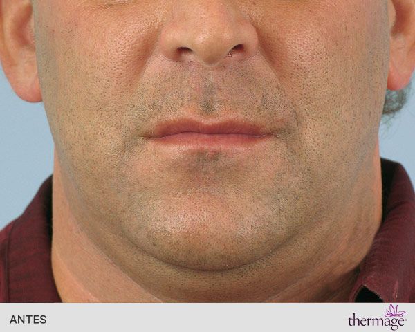 radiofrecuencia thermage facial antes