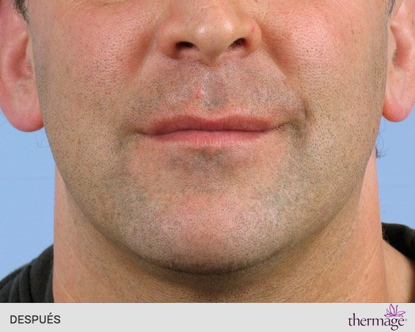 radiofrecuencia thermage facial después