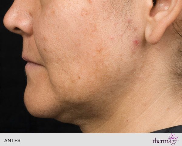 thermage facial antes