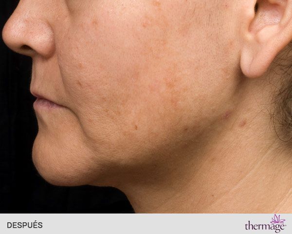 thermage facial después