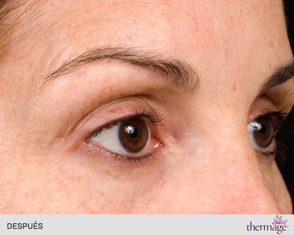 thermage ojos después
