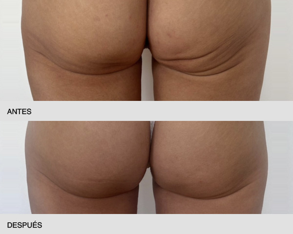 tratamiento flacidez glúteos