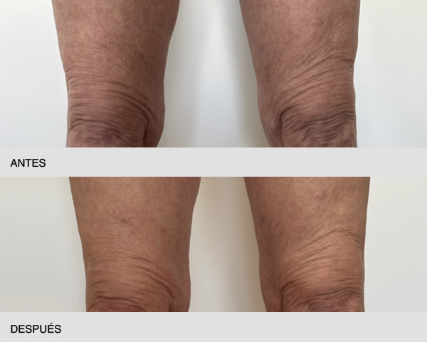 tratamiento flacidez piernas