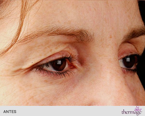 flacidez facial antes