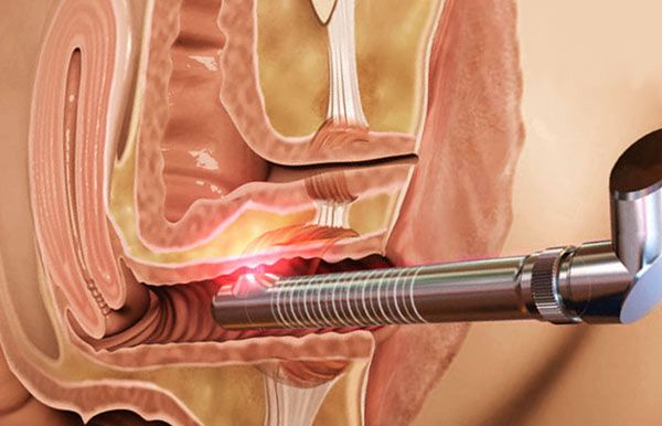 tratamiento láser CO2 vaginal