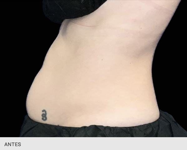 EMS Sculpt NEO abdomen antes