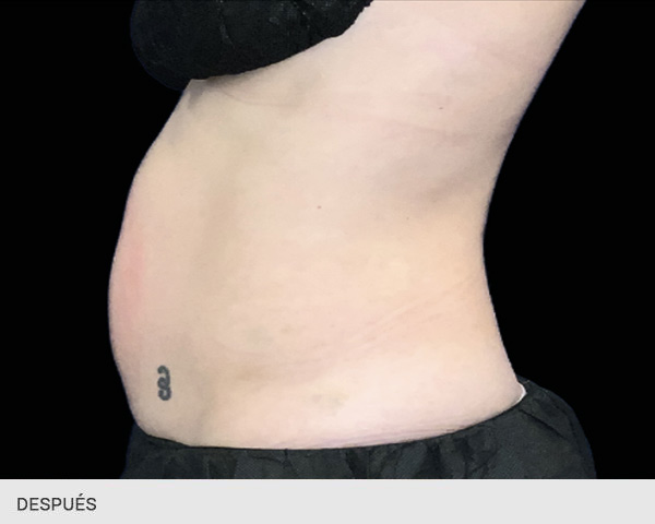 EMS Sculpt NEO barriga después