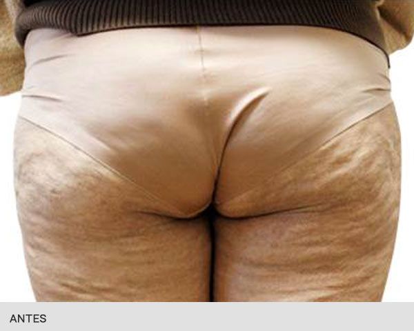 eliminar celulitis glúteos antes