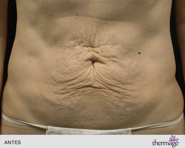 radiofrecuencia abdominal antes