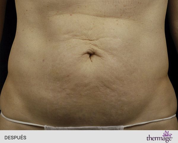 radiofrecuencia abdominal después