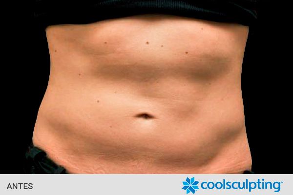 reducir o eliminar grasa localizada barriga antes