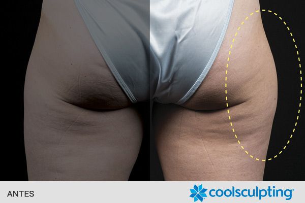 reducir o eliminar grasa localizada glúteos antes