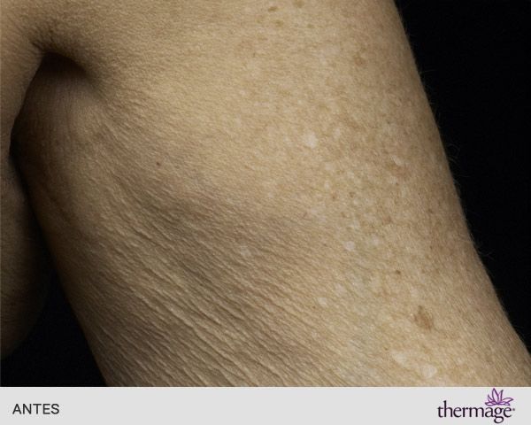 thermage brazos antes