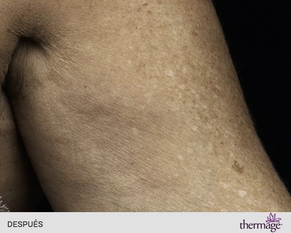 thermage brazos después